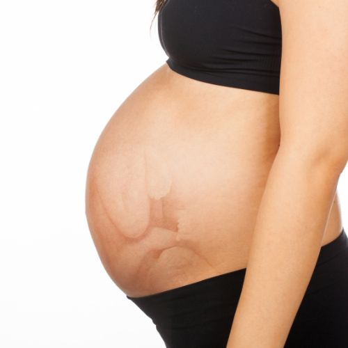 Breech Presentation