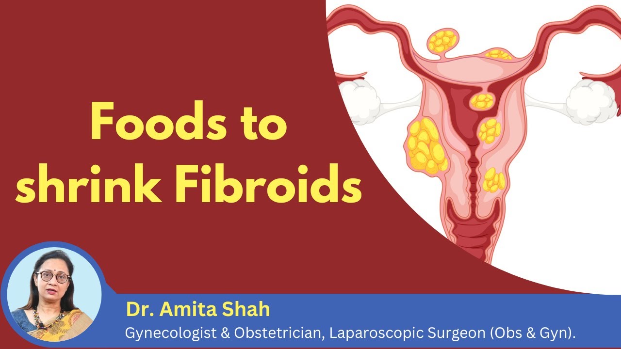 How to shrink the growth of fibroids Fibroid shrinking foods Dr. Amita Shah
