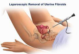Laparoscopic Removal of Uterine Fibroids