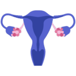 Recurrence of <br>Fibroids