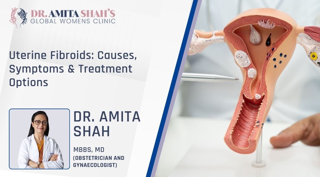 Uterine Fibroids Causes, Symptoms & Treatment Options