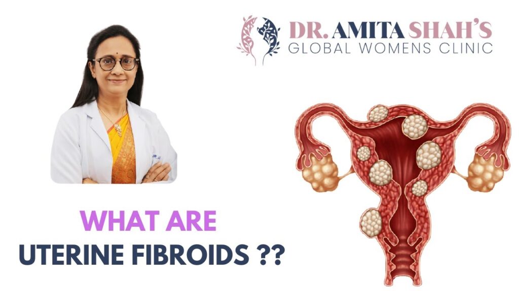 What are Fibroids Types Symptoms and Treatment Uterine Fibroids Dr Amita Shah