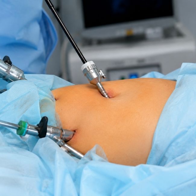 Laparoscopic Myomectomy in Gurgaon | Fibroid Removal Surgery by Dr. Amita Shah