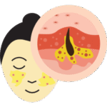 Acne and oily<br>skin