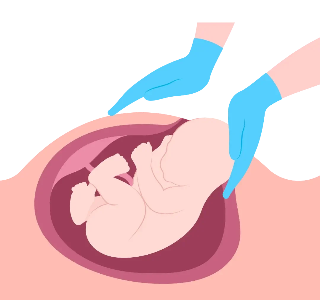 c-section delivery