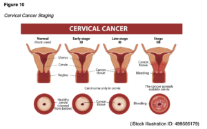 cervical cancer Stagging