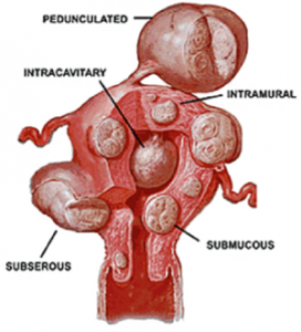 treatment of fibroids